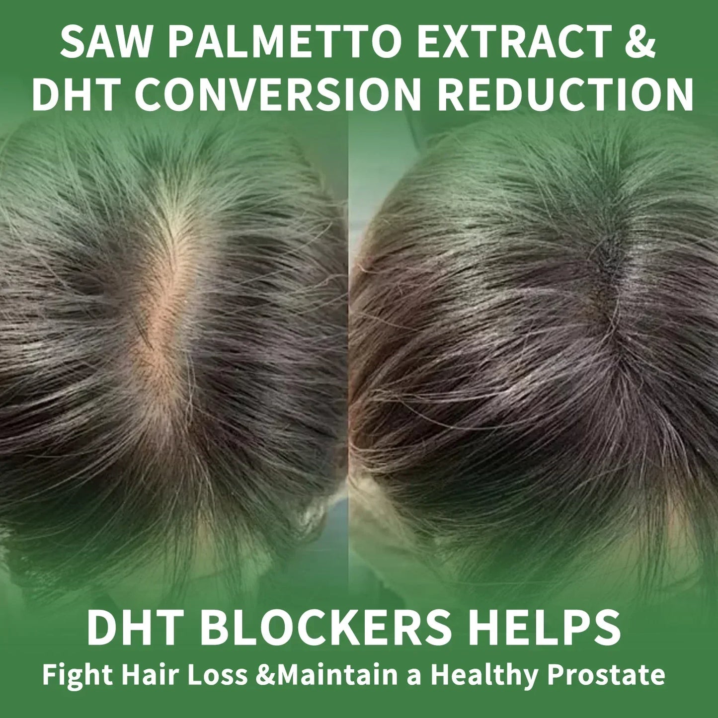Prostate Support, Prevents Hair Loss, Urinary Tract Health