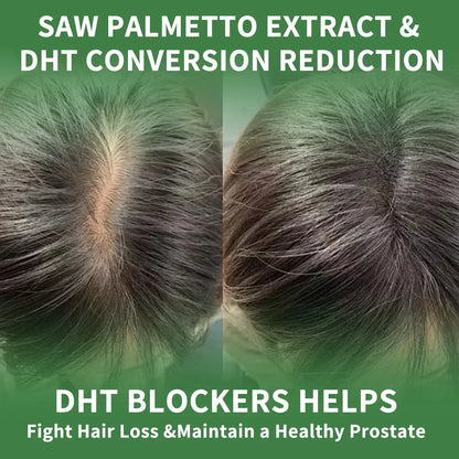 Prostate Support, Prevents Hair Loss, Urinary Tract Health
